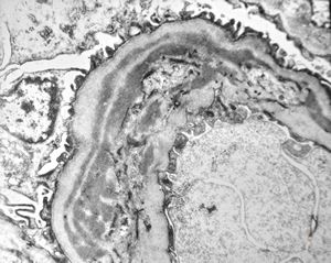 type I membranoproliferative glomerulonephritis type I membranoproliferative glomerulonephritis